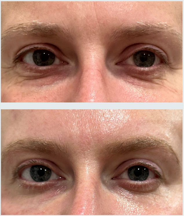 Voor en na resultaat van de RRS HA Eyes eyebooster behandeling rondom de ogen