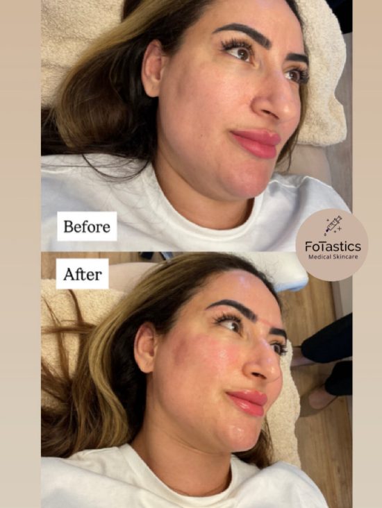 before-after-1xzalmdna