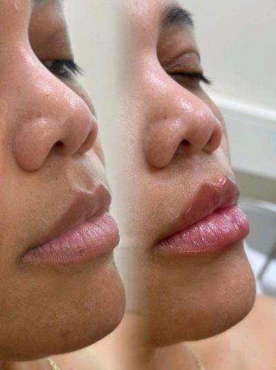 before-after-lipfillers