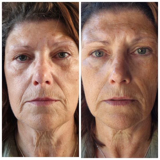 infuzion skinboosters