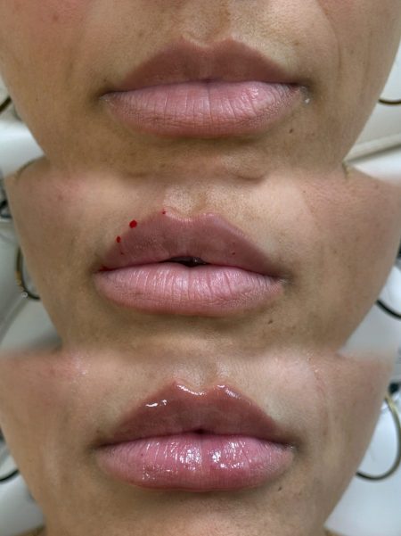lipfiller_tijdensbehandeling